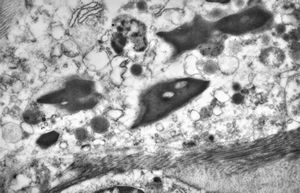M,43y. | blood - susp. myeloid leukemia -Auer bodies M,43y. | blood - susp. myeloid leukemia -Auer bodies